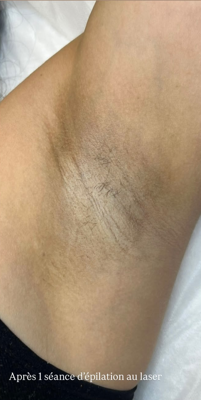 Après — Épilation au laser