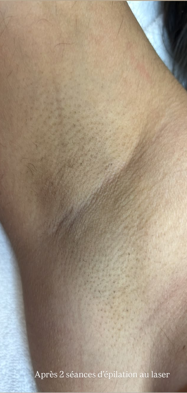 Après — Épilation au laser