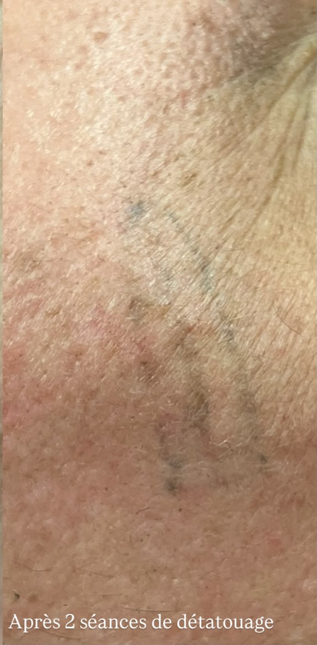 Après — Détatouage