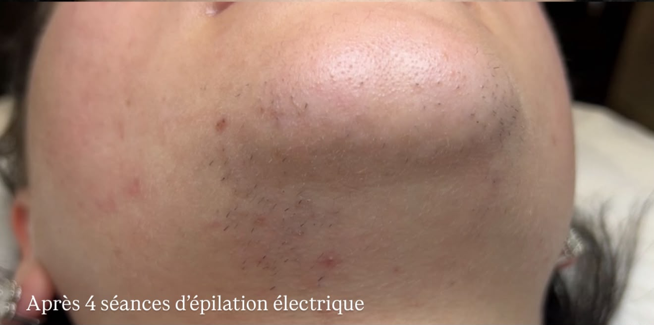 Après — Épilation électrique